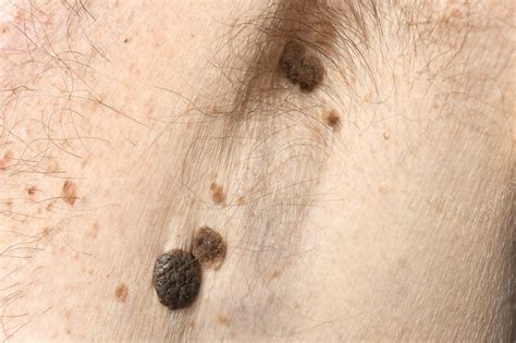 melanoma in lymph nodes found